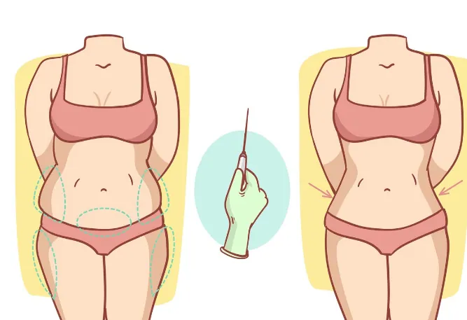 Liposuction (fat removal)