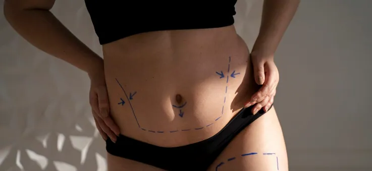 Liposuction (fat removal)